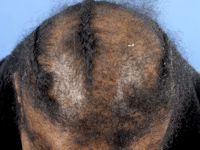 Tractie alopecia