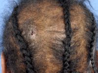 Tractie alopecia