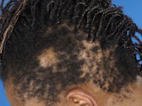 Tractie alopecia