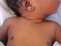 Transiente neonatale pustuleuze melanosis