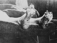 Trench foot, maceratio cutis pedum