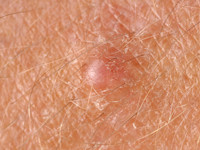 Trichilemmale cyste, pilar cyst