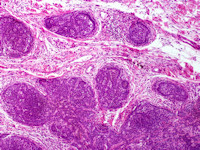 Trichoblastoma
