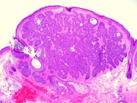 Trichoepithelioma