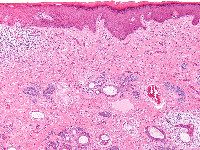 Trichoepithelioma