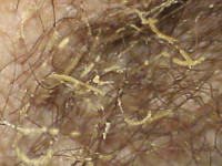 Trichomycosis axillaris