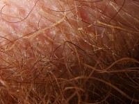 Trichomycosis axillaris