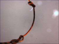 Trichonodosis (knoopjes in het haar)