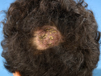 Trichophyton tonsurans