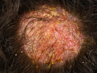 Trichophyton tonsurans