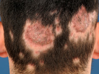 Trichophyton tonsurans