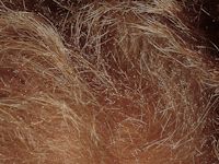 Trichorrhexis nodosa