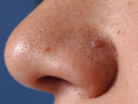 Trichostasis spinulosa