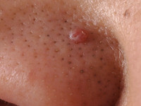 Trichostasis spinulosa