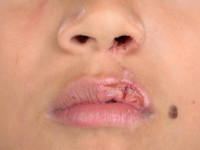 Trigeminal trophic syndrome