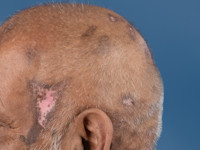 Trigeminal trophic syndrome