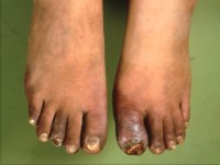 Ziekte van Buerger, tromboangiitis obliterans