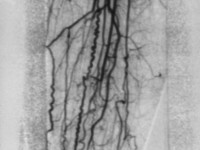 Ziekte van Buerger, tromboangiitis obliterans