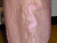 Thrombophlebitis