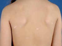 Ash leaf macula (es blad) bij tubereuze sclerose