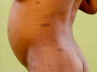 Café au lait macula