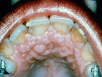 Fibromatose van de gingiva bij tubereuze sclerose