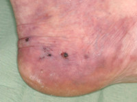 Ulcera door hyperhomocysteïnemie bij MTHFR mutatie