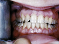 Ulcerative gingivitis
