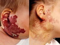 Ulcererend hemangioma