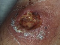 Atypische mycobacteriën