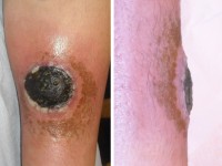 Ulcus bij granulocytopenie