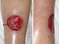 Ulcus bij granulocytopenie