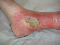 Ulcus cruris venosum