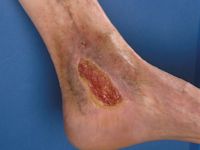 Ulcus cruris venosum