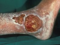 Ulcus cruris venosum