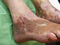 Ulcus cruris venosum