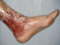 Ulcus cruris venosum