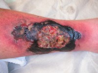 Ulcus cruris door beta-hemolytische streptokok