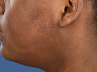 Ulerythema ophryogenes