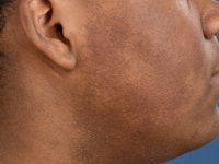 Ulerythema ophryogenes