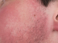 Ulerythema ophryogenes