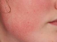 Ulerythema ophryogenes