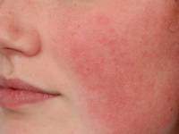 Ulerythema ophryogenes