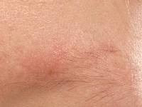 Ulerythema ophryogenes