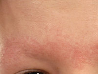 Ulerythema ophryogenes