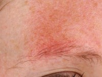Lateral eyebrow loss in ulerythema ophryogenes