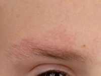 Laterale wenkbrauwuitval bij ulerythema ophryogenes
