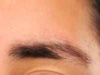 Laterale wenkbrauwuitval bij ulerythema ophryogenes