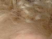 Uncombable hair syndrome