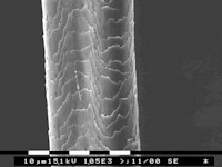 Uncombable hair syndrome